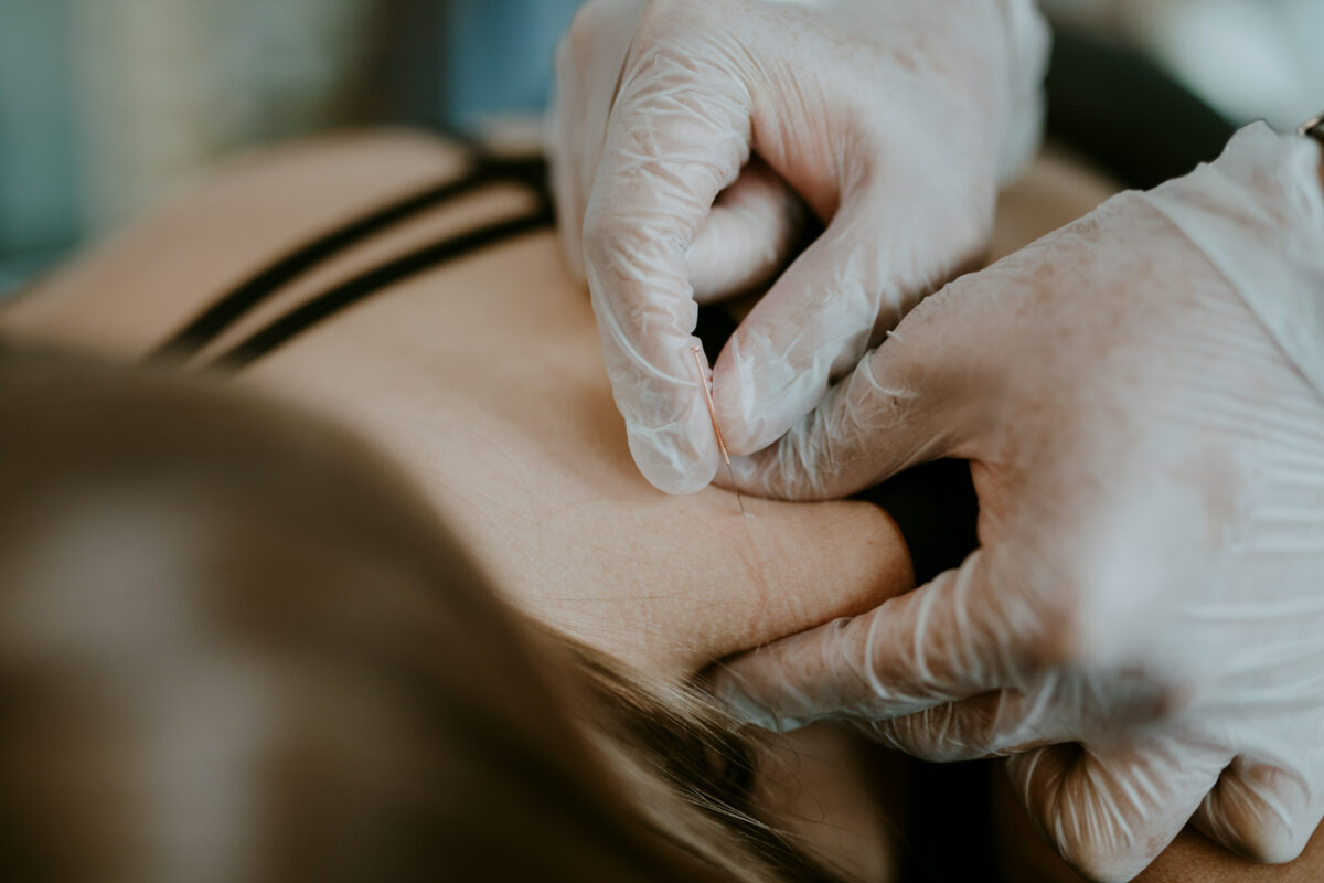 Acupuncture Treatment | Allied Physiotherapy Health Group | Lower Mainland