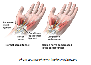 in carpal tunnel syndrome the __________ is compressed