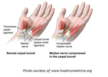 Physiotherapy in Medicine Hat for Hand - Carpal Tunnel Syndrome