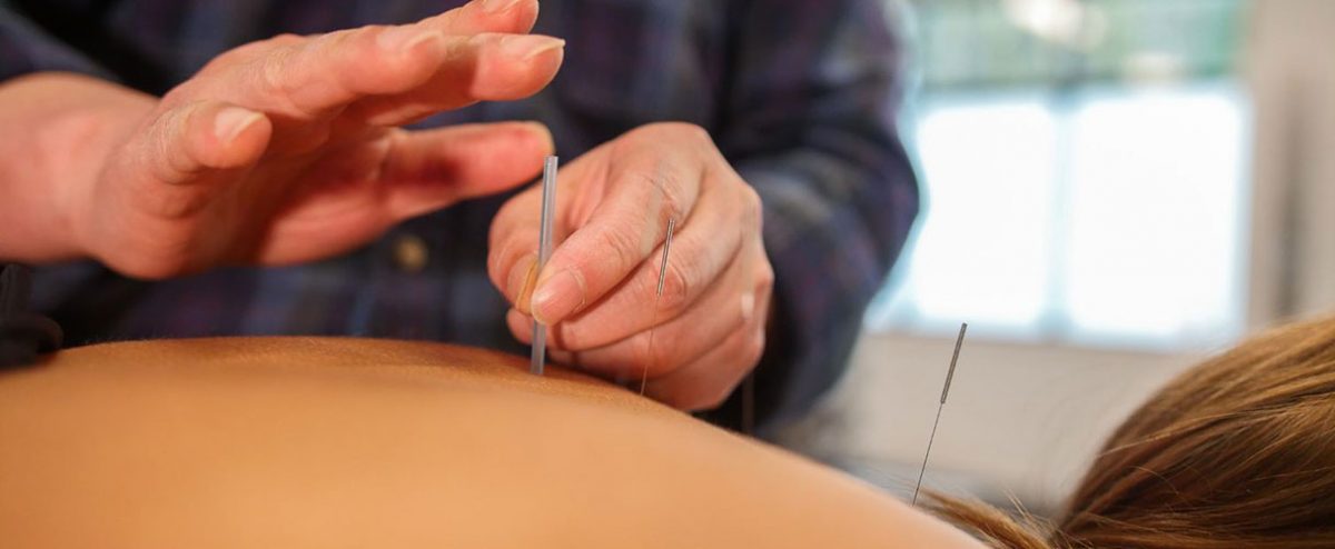 Traditional Chinese Medicine Acupuncture | Allied Physiotherapy Health Group